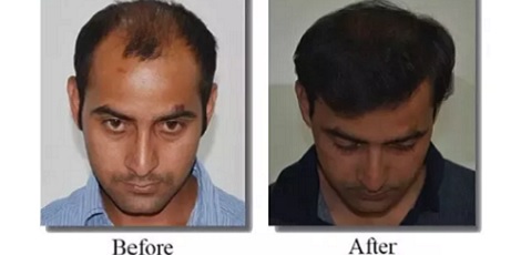 Live Chennai: How much does a hair transplant cost in Chennai,chennai hair transplant, cost in chennai Live Chennai: How much does a hair transplant cost in Chennai,chennai hair transplant, cost in chennai