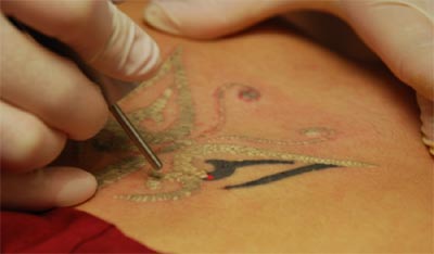 Permanent Tattoo Removal in Chennai  Tattoos Removal in Chennai